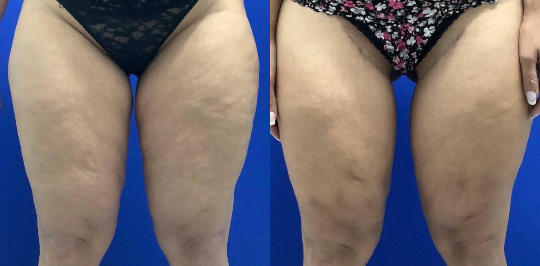 Medial Thigh Lift Dallas Before & After | COX