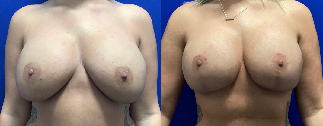 Breast Lift Dallas Before & After | COX