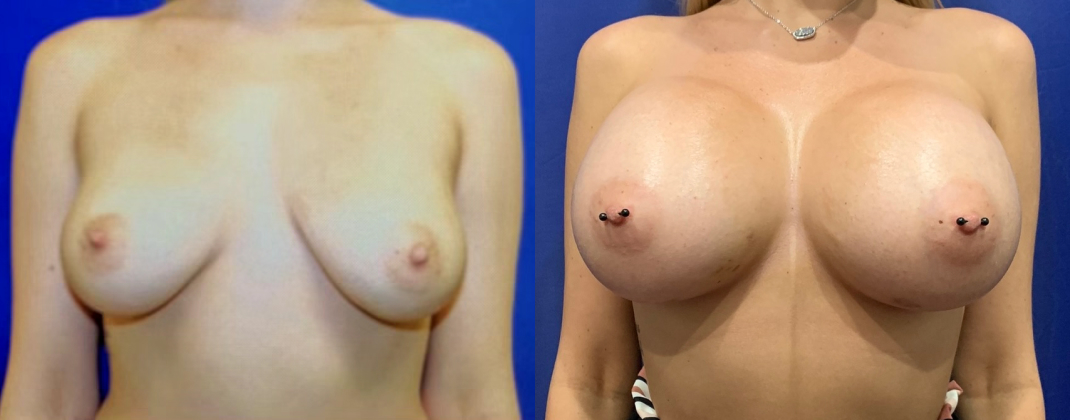 Breast Augmentation Dallas Before & After | COX
