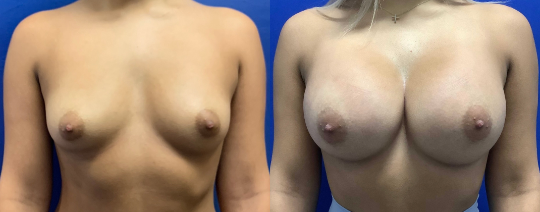 Breast Augmentation Dallas Before & After | COX