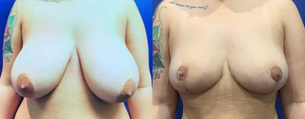 Breast Reduction Dallas Before & After | COX