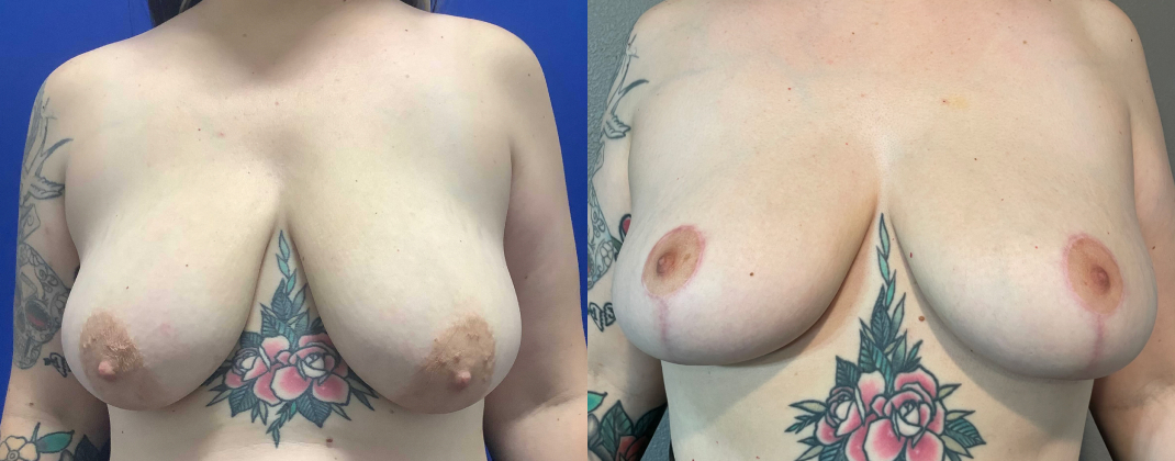 Breast Reduction Dallas Before & After | COX