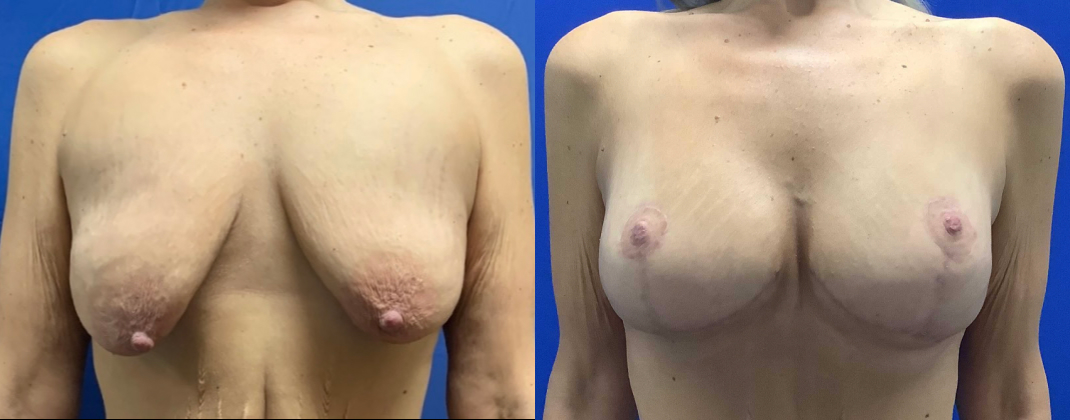 Breast Augmentation with Lift Dallas Before & After | COX