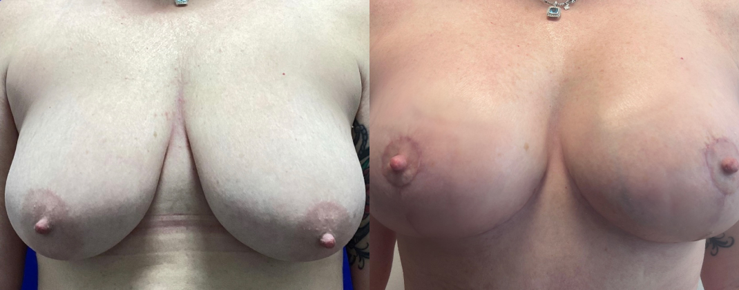 Breast Augmentation with Lift Dallas Before & After | COX