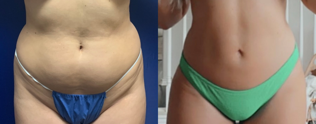 360 Liposuction Dallas Before & After | COX