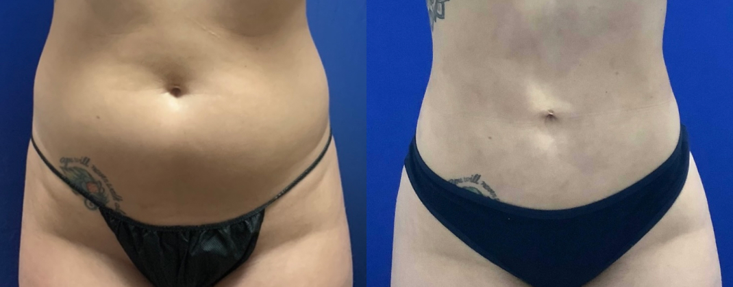 360 Liposuction Dallas Before & After | COX