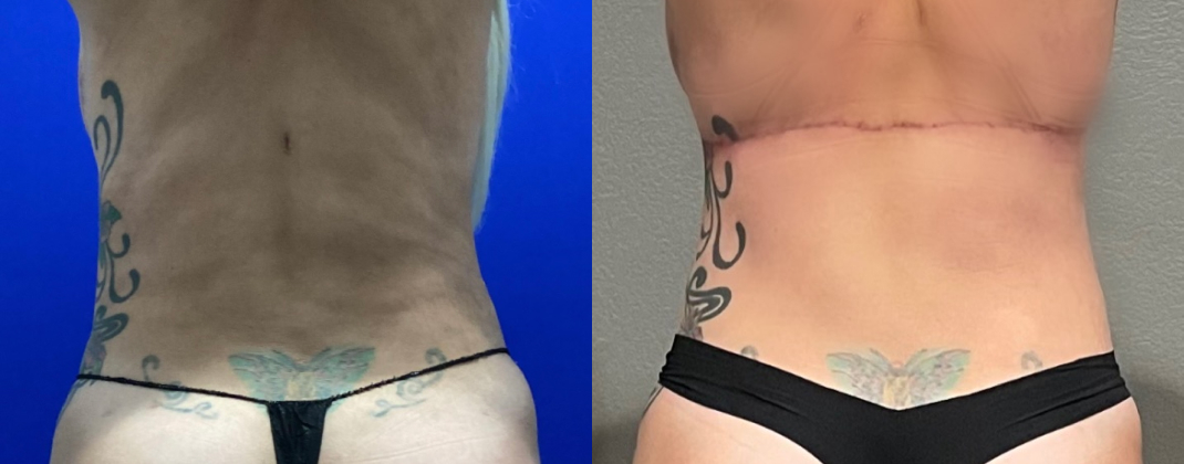 Back Bra Lift Dallas Before & After | COX