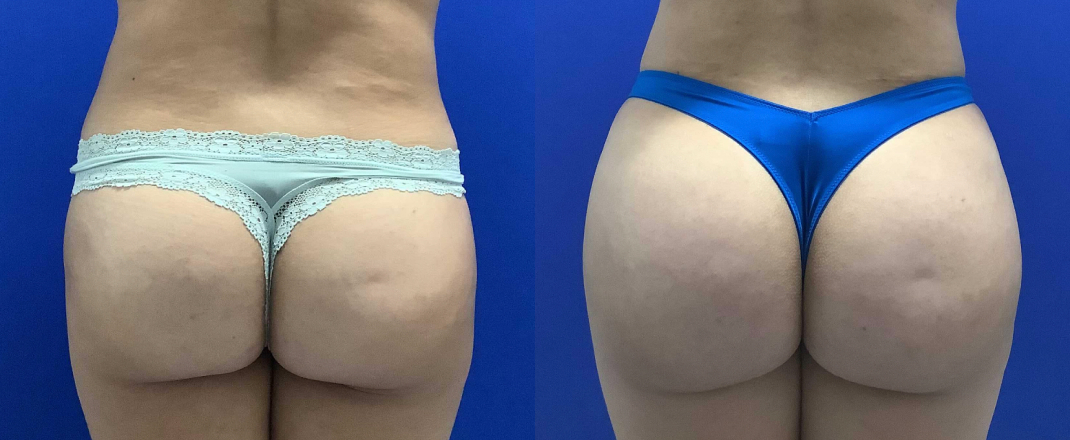 Brazilian Butt Lift Dallas Before & After | COX