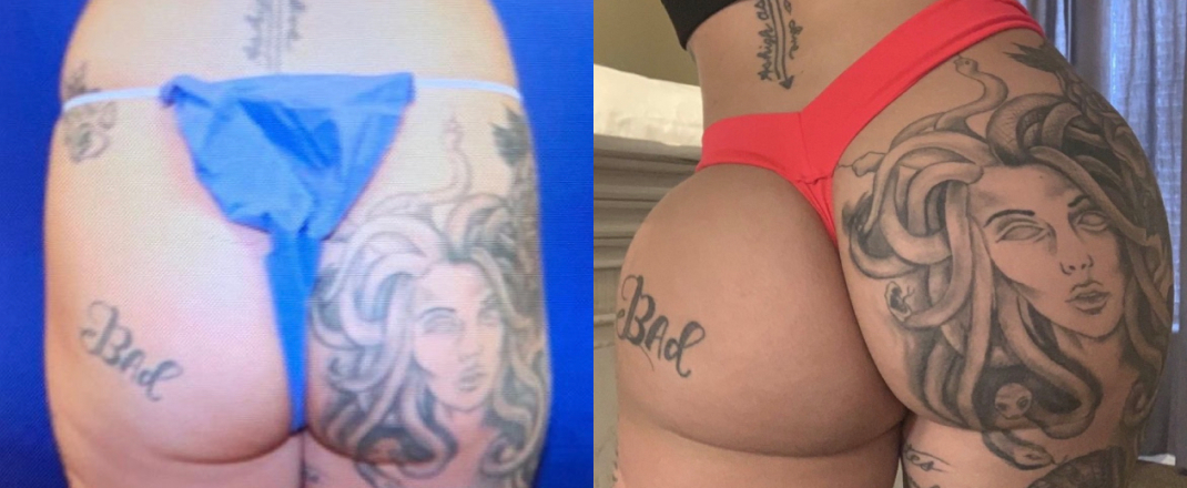 Brazilian Butt Lift Dallas Before & After | COX