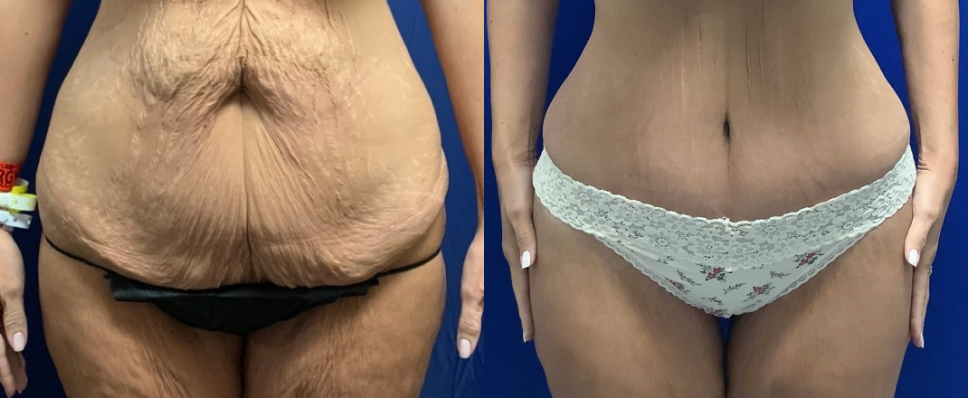 Abdominoplasty Dallas Before & After | COX