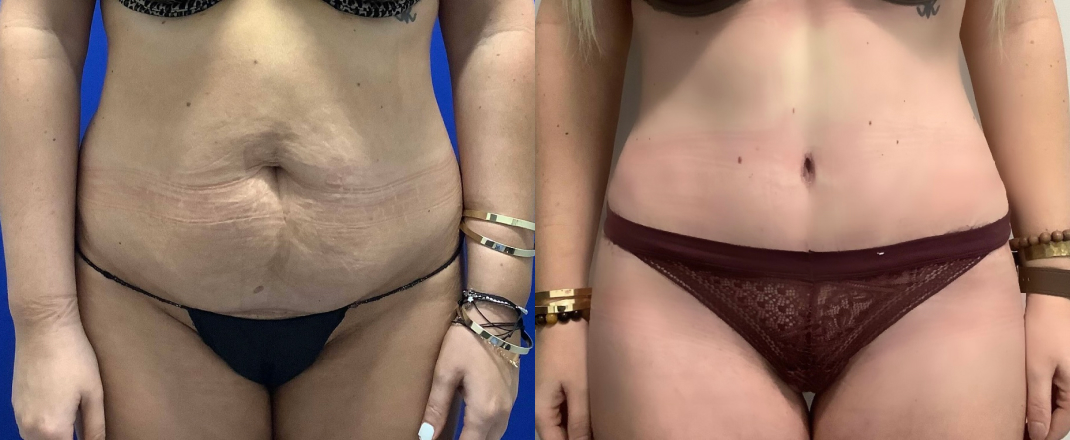 Abdominoplasty Dallas Before & After | COX