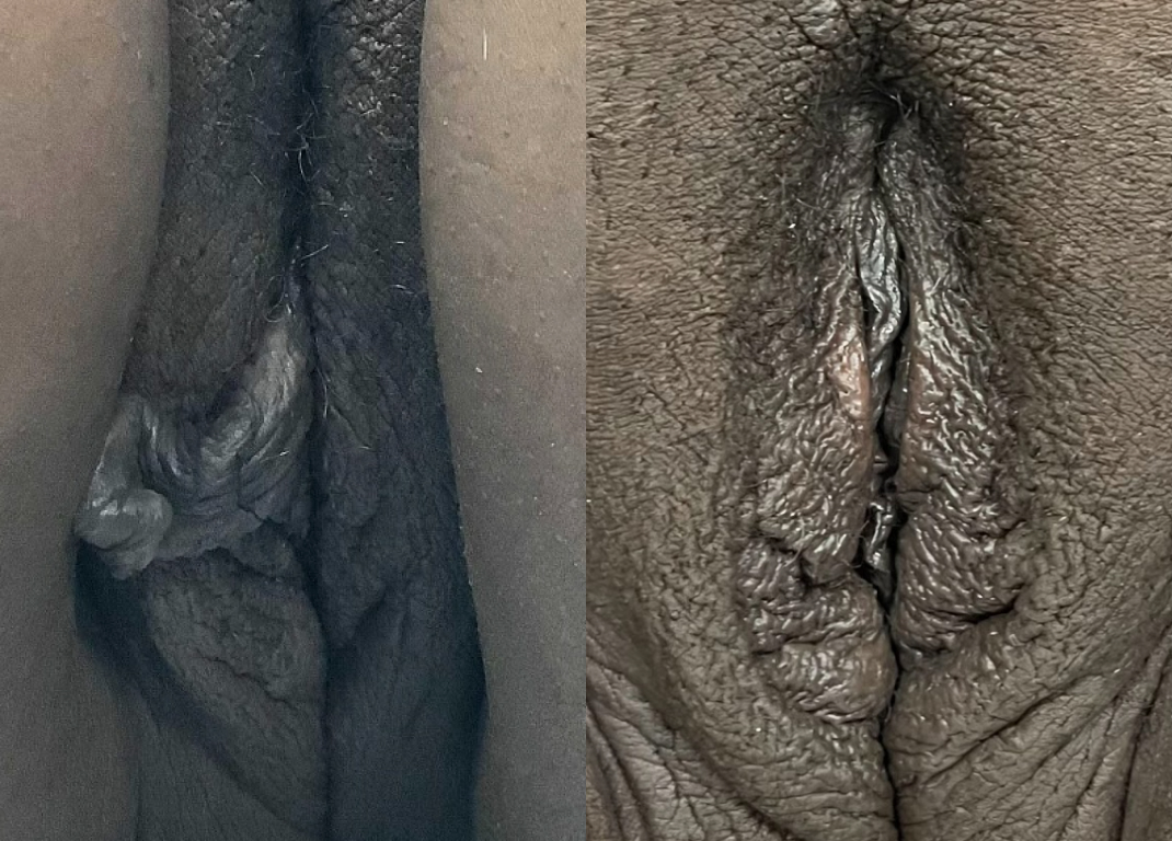 Labiaplasty Dallas Before & After | COX