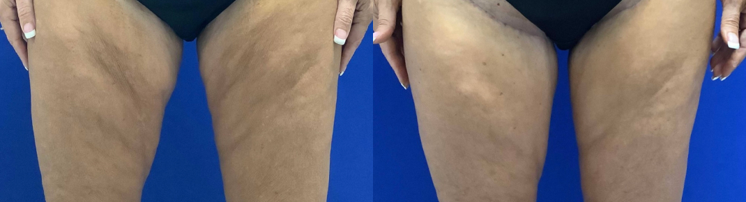 Medial Thigh Lift Dallas Before & After | COX