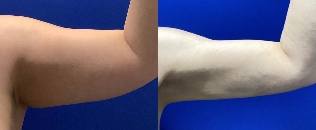 Arm Liposuction Dallas Before & After | COX