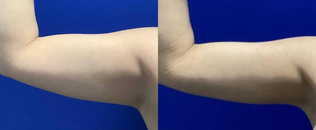 Arm Liposuction Dallas Before & After | COX