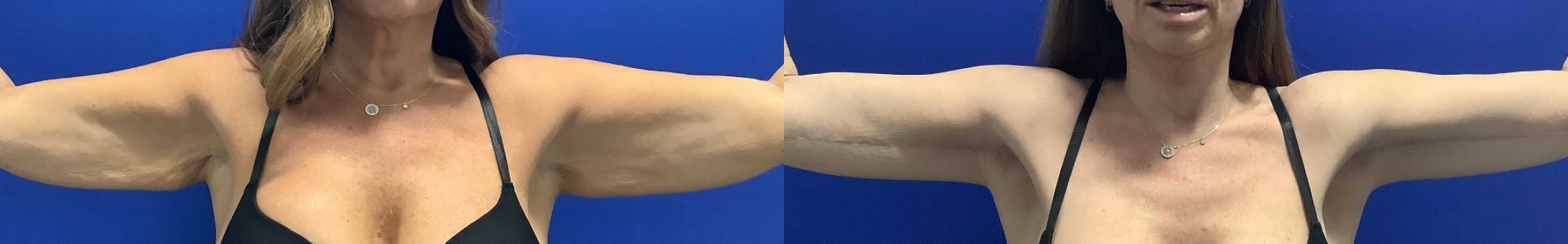 Brachioplasty Dallas Before & After | COX