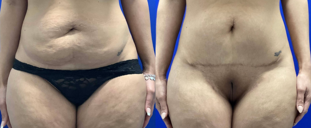 Mini-Abdominoplasty Dallas Before & After | COX
