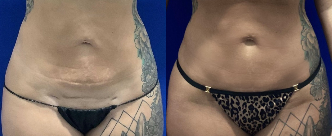 Mini-Abdominoplasty Dallas Before & After | COX