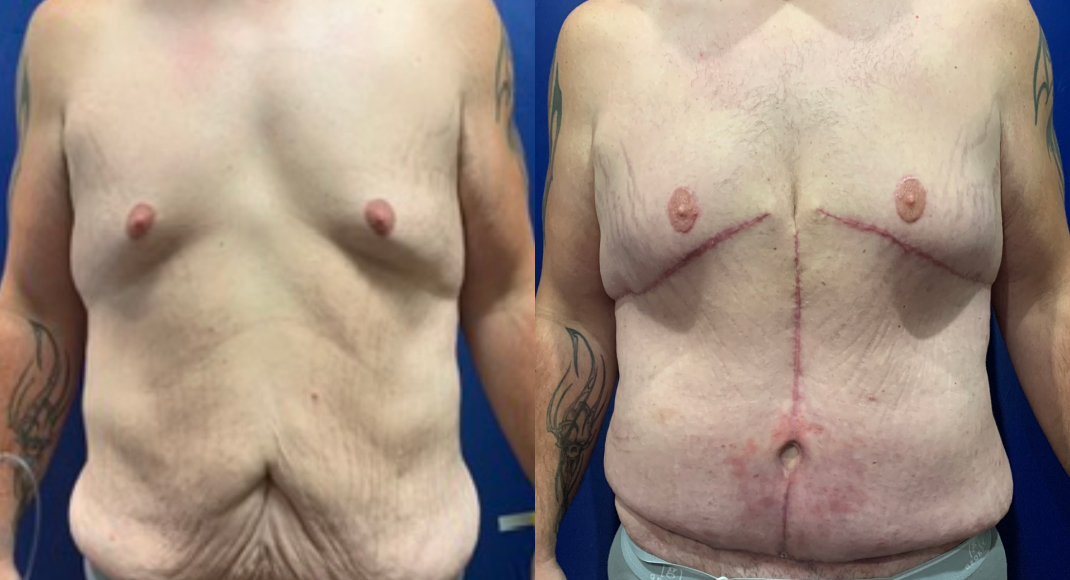 Fleur-de-Lis Abdominoplasty Dallas Before & After | COX