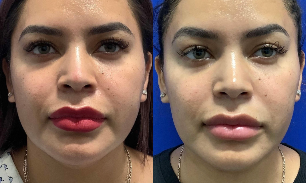 Buccal Fat Pad Removal Dallas Before & After | COX