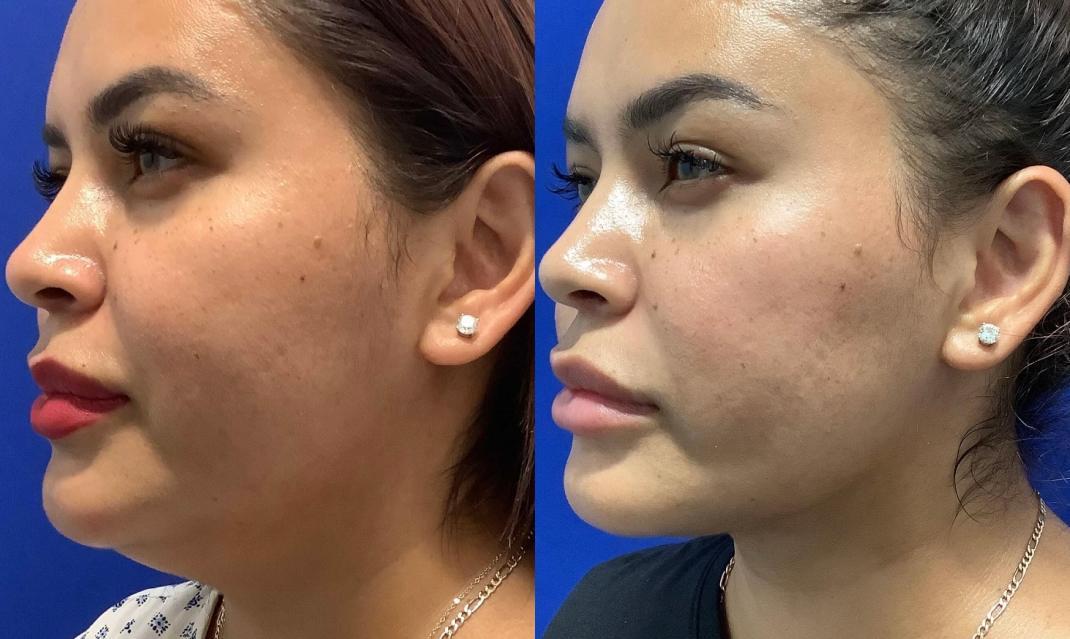 Buccal Fat Pad Removal Dallas Before & After | COX