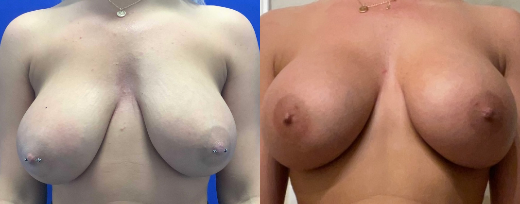 Breast Implant Exchange Dallas Before & After | COX